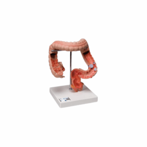 Enfermedades del tracto intestinal