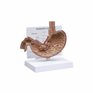 Modelo de cáncer de estómago